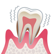 重度歯周病歯周病